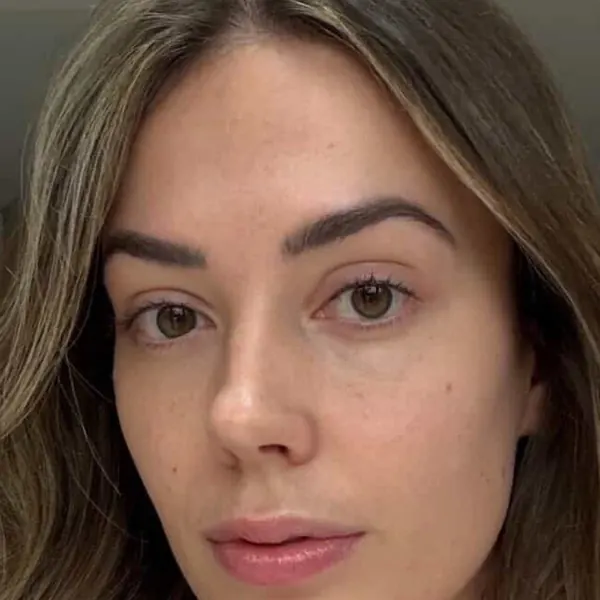Under-eye area after polynucleotide treatment