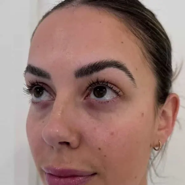 Under-eye area before polynucleotide treatment