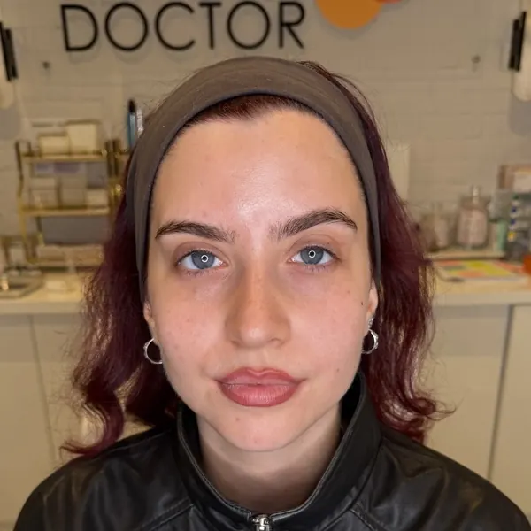 Face after skin booster treatment