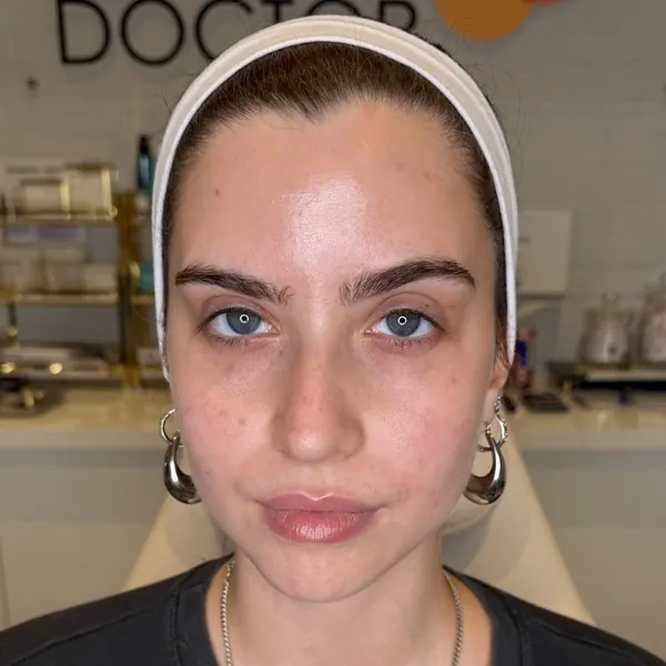 Face before skin booster treatment